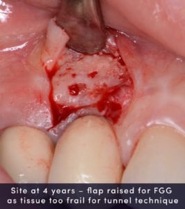 Site-at-4-years-–-flap-raised-for-FGG-as-tissue-too-frail-for-tunnel-technique-266x300